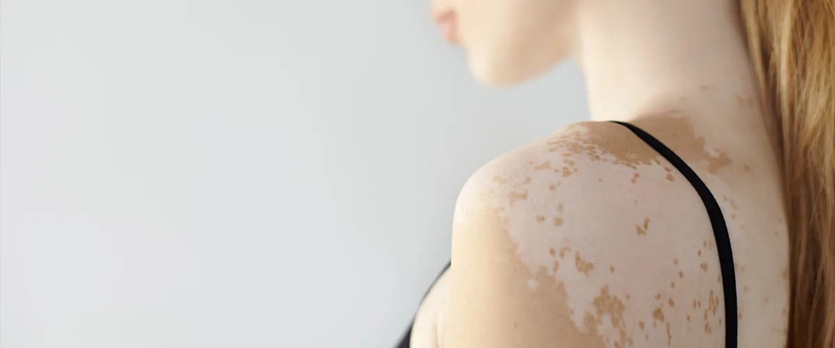 Vitiligo Nasıl Tedavi Edilir?